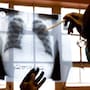 BC realiza 90% de diagnósticos de tuberculosis con métodos moleculares