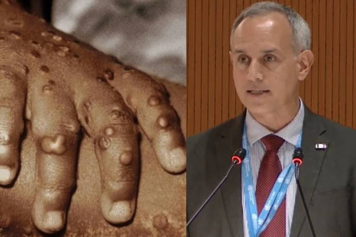 Confirman segundo caso de viruela del mono en CDMX