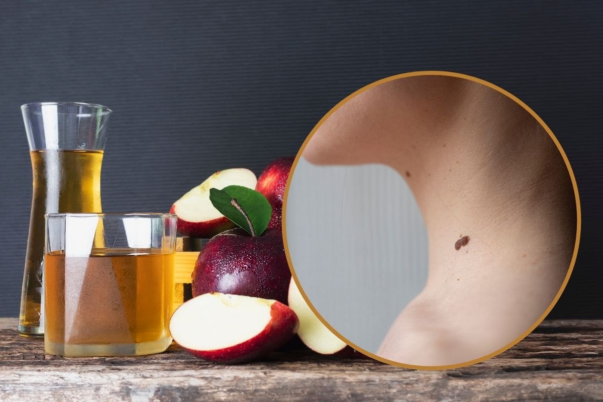 Cómo eliminar verrugas con vinagre de manzana
