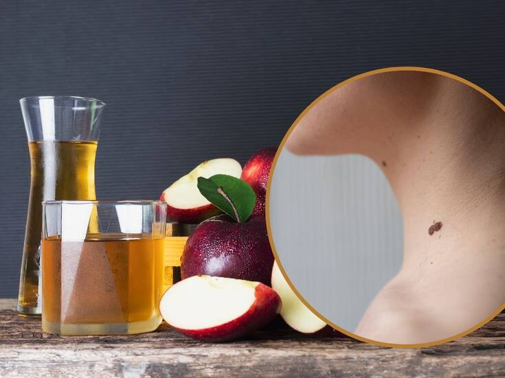 Cómo eliminar verrugas con vinagre de manzana
