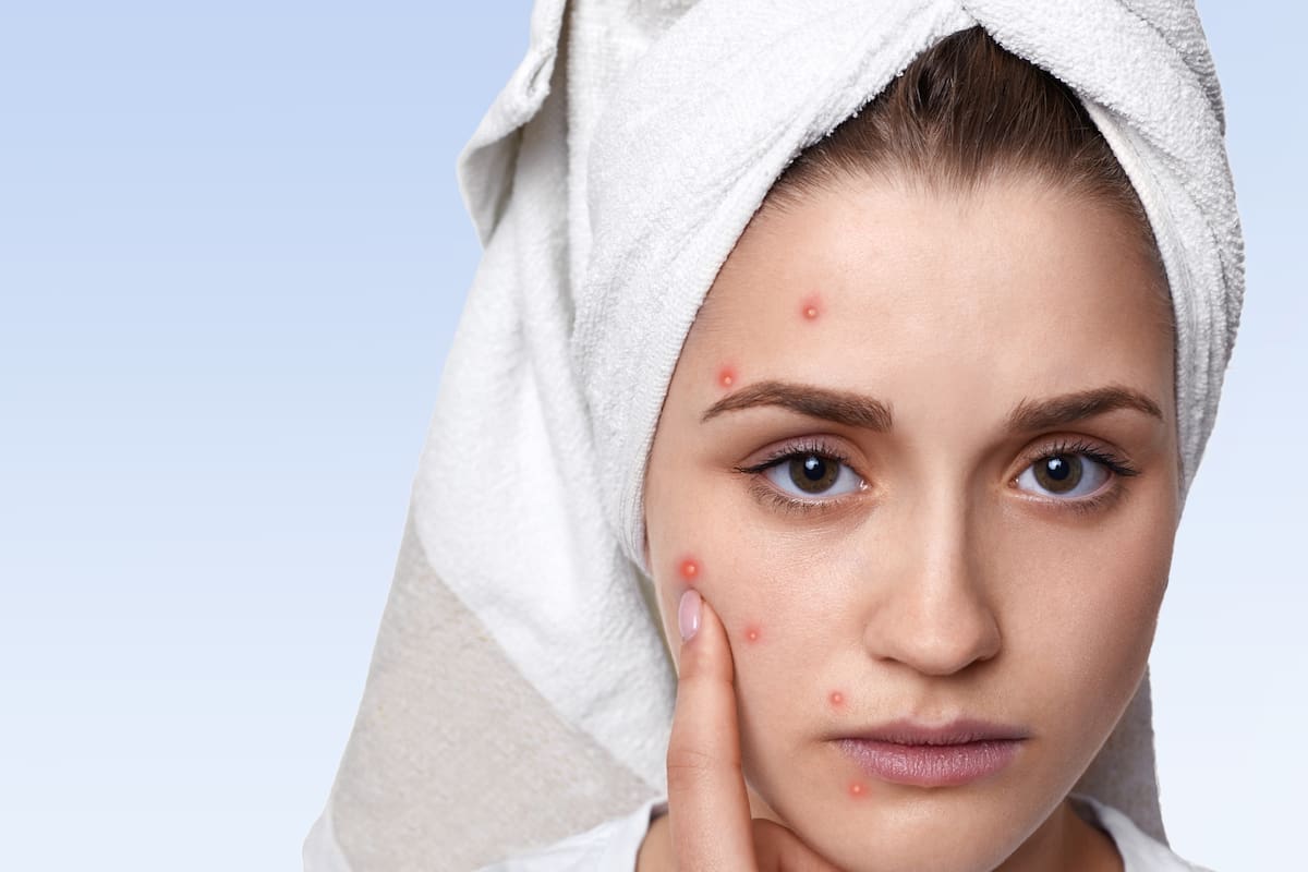 Parches para granos: qué ofrecen y qué no pueden resolver