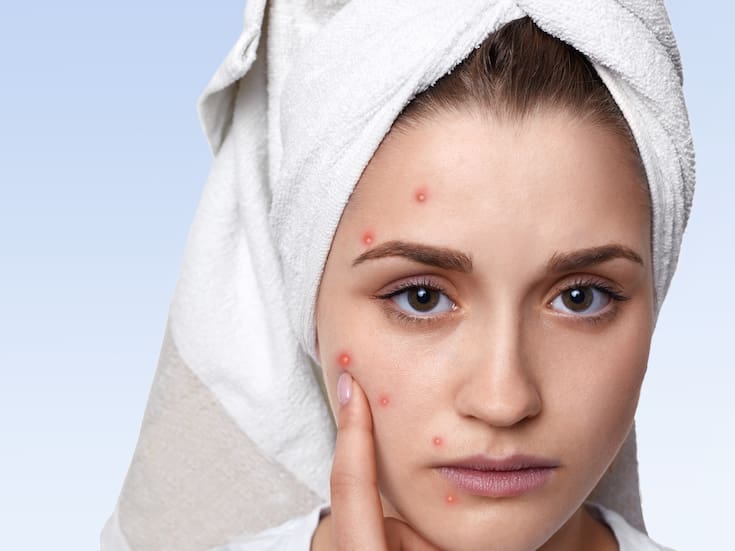 Parches para granos: qué ofrecen y qué no pueden resolver