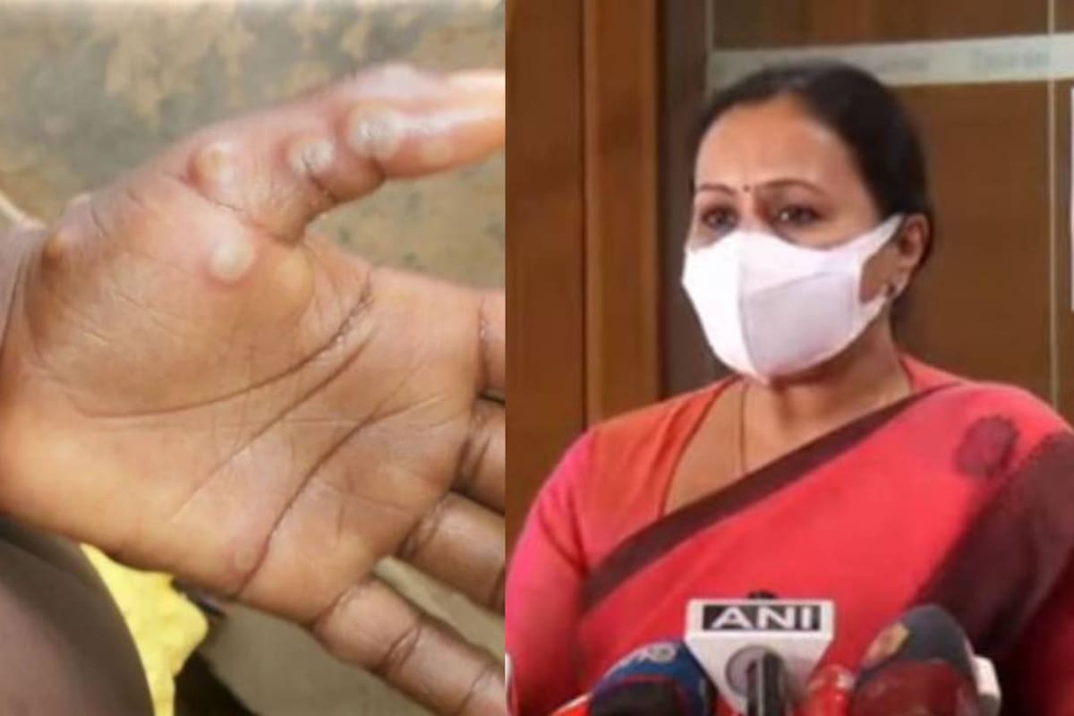 India: Confirman primer fallecimiento de paciente con viruela del mono