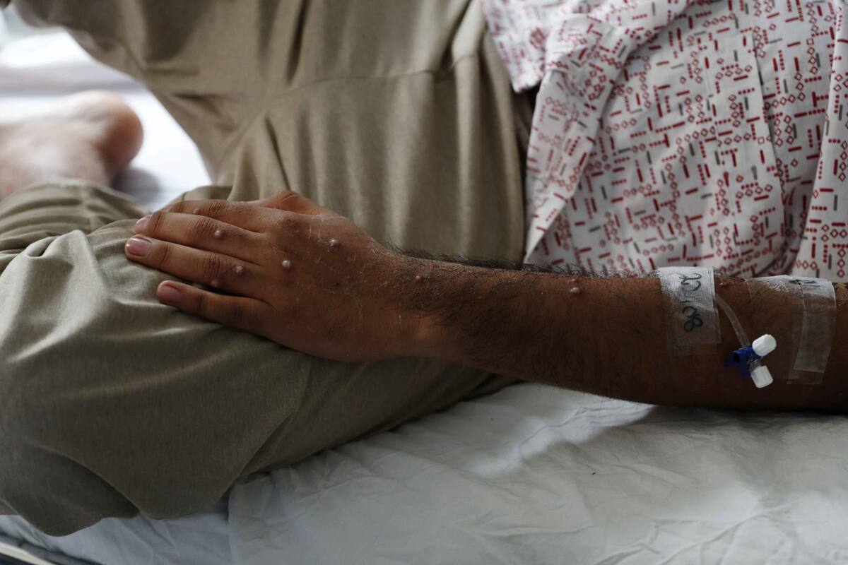 Secretaría de Salud sube niveles de alerta para viajeros mexicanos ante peligro por Mpox
