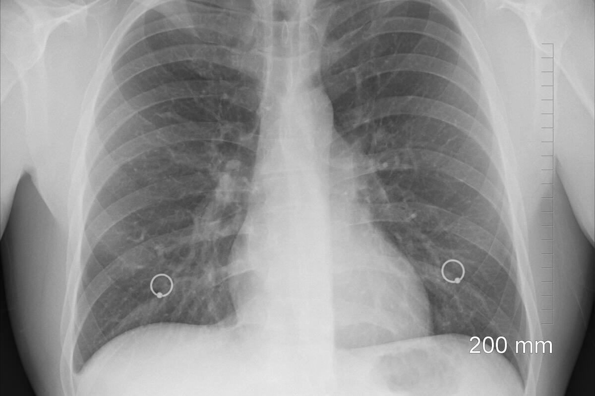 Conoce qué es la tuberculosis pulmonar y sus síntomas