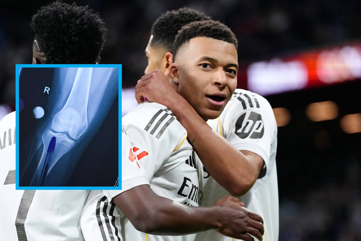 ¡Escándalo en España! Los médicos del Real Madrid se equivocaron de rodilla en el diagnóstico de Kylian Mbappé y lo hicieron jugar tres partidos con una lesión