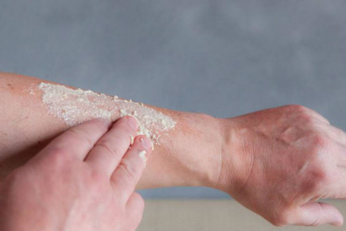 Urticaria crónica: Más que simples ronchas