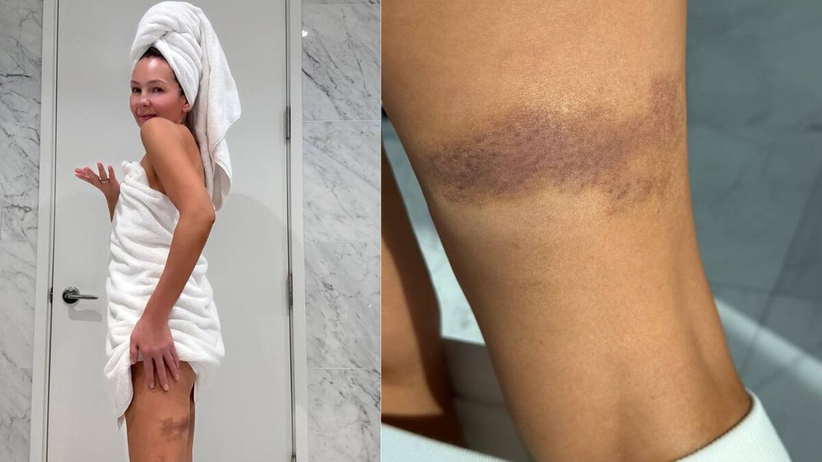 Thalía comparte imágenes de las lesiones que sufrió como parte de su presentación en Premio Lo Nuestro