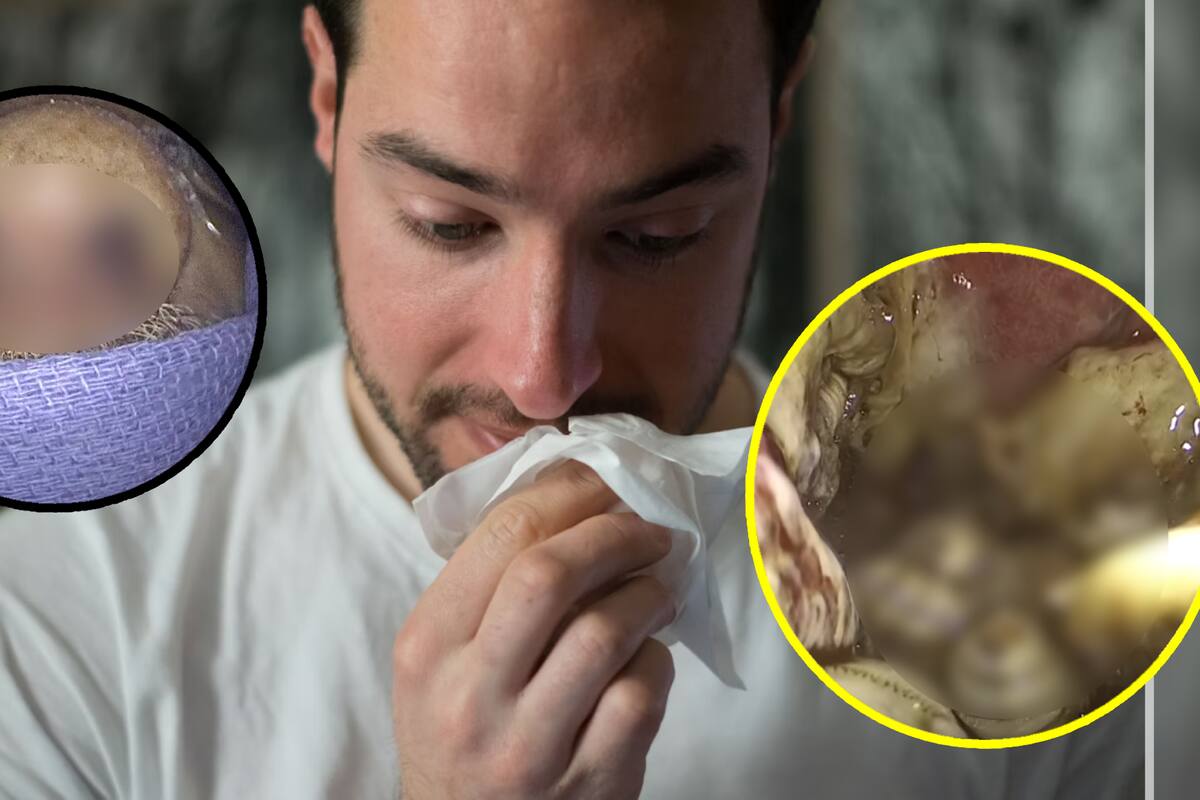 VIDEO: Hombre de Florida tenía 150 larvas vivas dentro de su nariz alimentándose de él