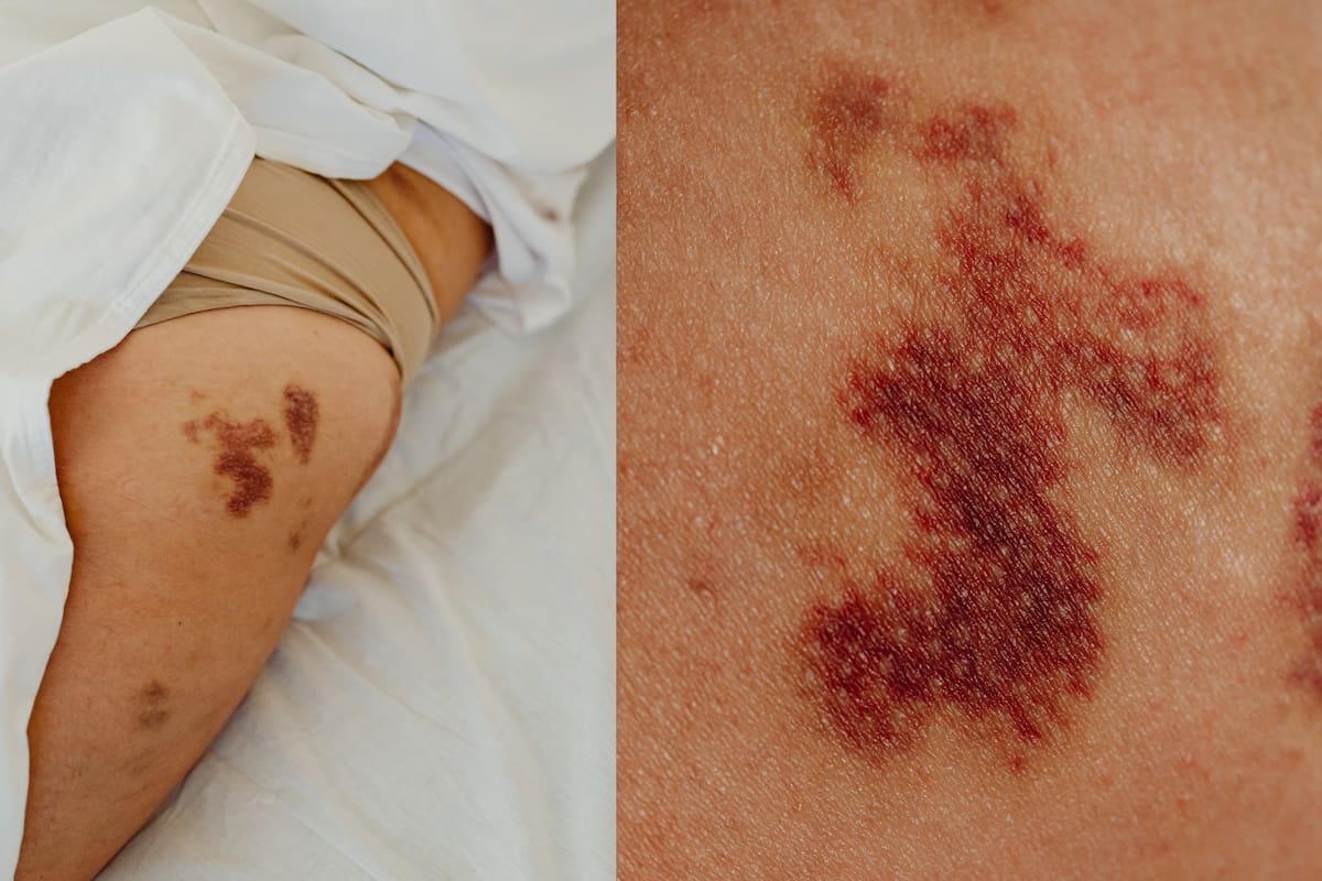 ¿Te salen moretones sin razón? Podrían estar relacionados con la vitamina C