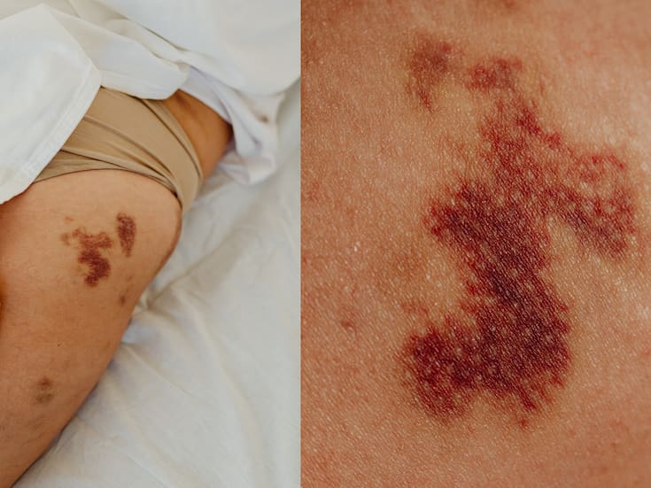 ¿Te salen moretones sin razón? Podrían estar relacionados con la vitamina C