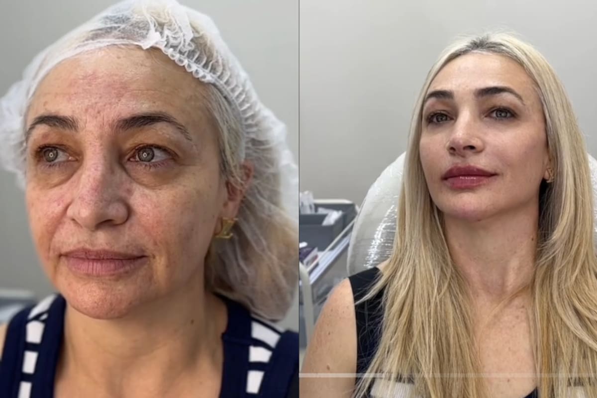 VIRAL | Médico estético en Colombia sorprende al rejuvenecer el rostro de esta mujer