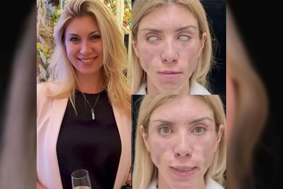 Yulia Tarasevich: Modelo rusa se operó para verse más joven y ahora no puede mover sus ojos ni cara