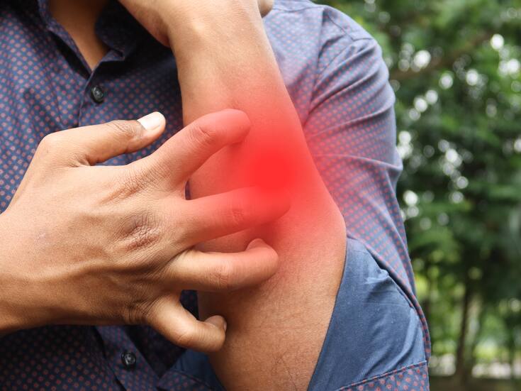 ¿Cómo saber si padeces psoriasis? Una enfermedad muy común y poco diagnosticada