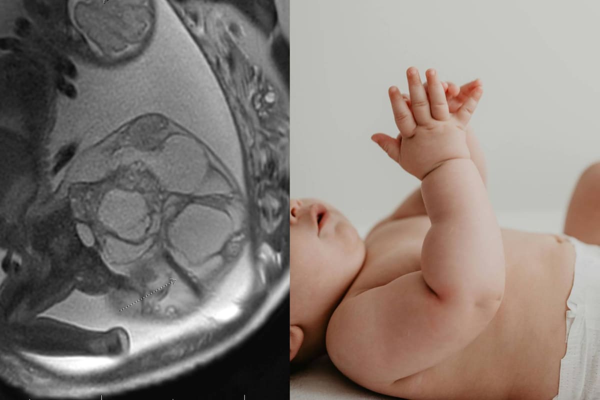 EU: Adalida, la bebé que nació con un tumor de 4 libras en el coxis; ¿Cuál fue el diagnóstico?