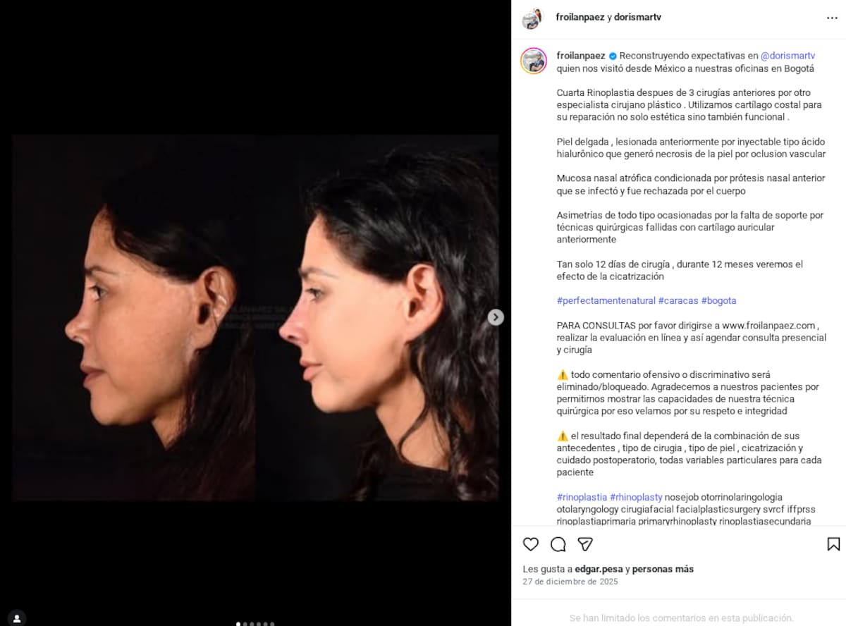Dorismar comparte nuevos avances de su reconstrucción nasal tras complicaciones en una cirugía estética | Captura de pantalla Instagram (@froilanpaez)