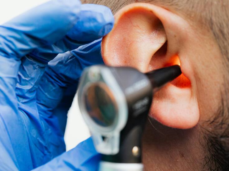 Un estudio revela que un medicamento para la disfunción eréctil podría revertir una forma genética de pérdida de audición, un hallazgo inesperado que abre nuevas vías de investigación en el oído interno