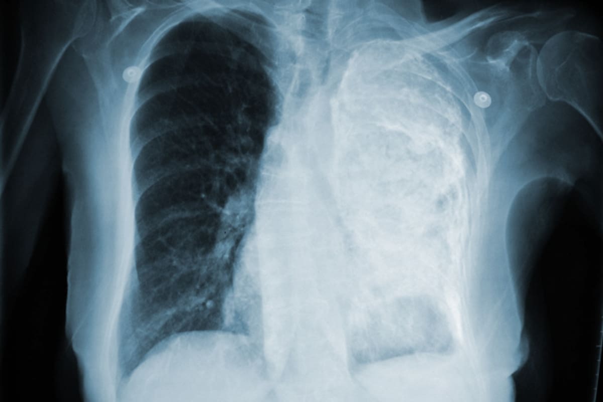 Ven a más jóvenes con daño pulmonar