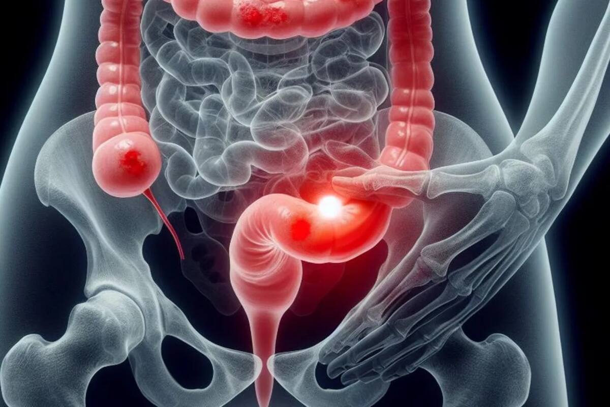El aumento del cáncer colorrectal entre adultos jóvenes: Señales de alerta y factores de riesgo