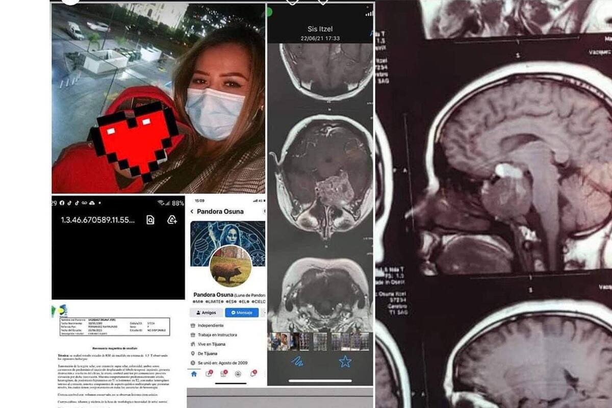 Madre soltera de Tijuana requiere apoyo para cirugía por tumor en el cerebro