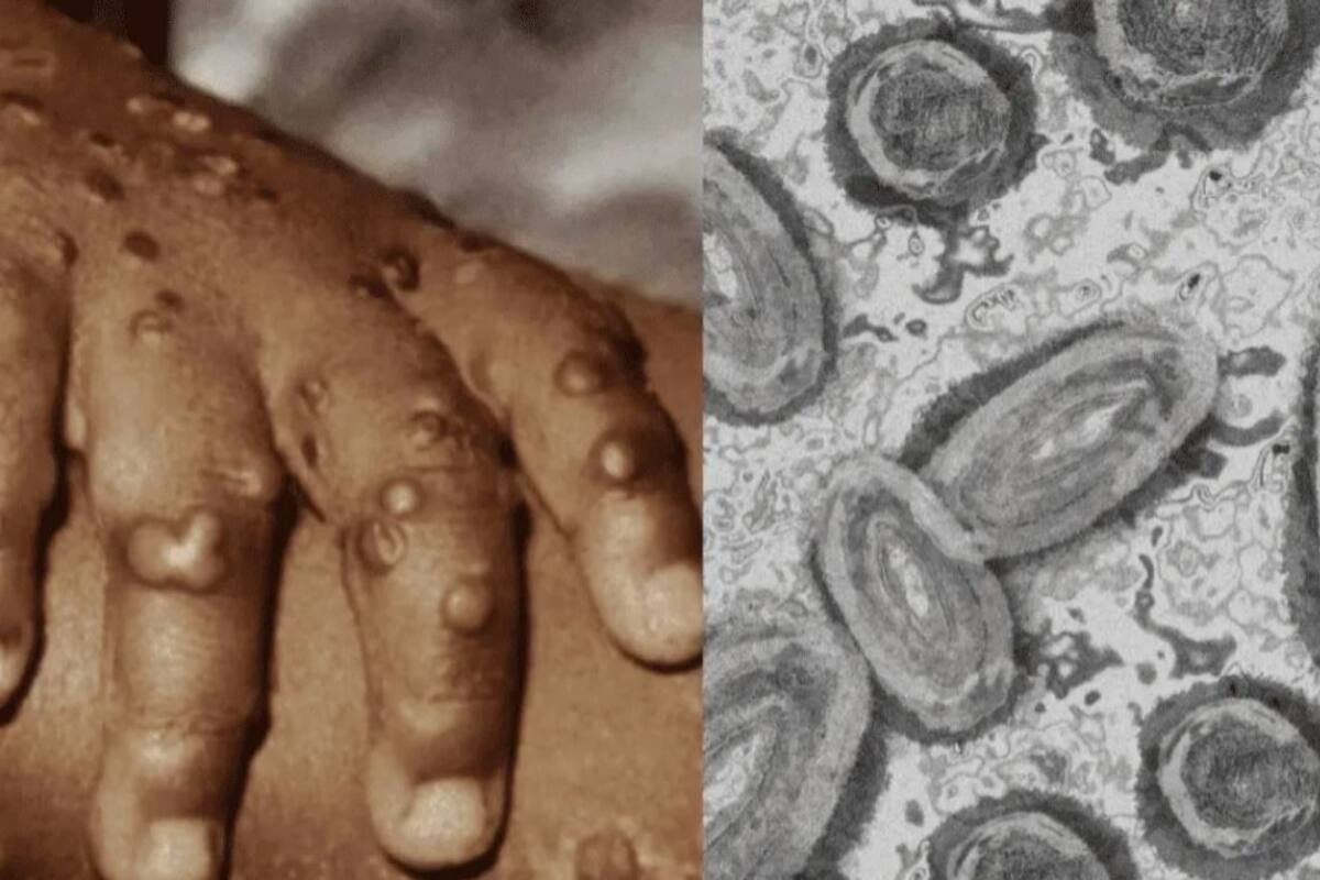 Se confirma el primer caso de viruela de mono en Hidalgo