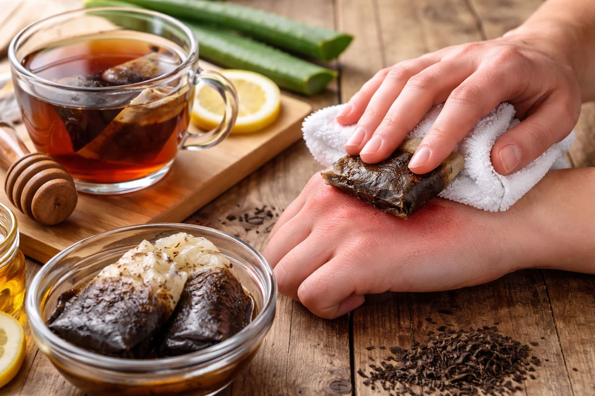 Cómo calmar quemaduras leves con compresas de té negro