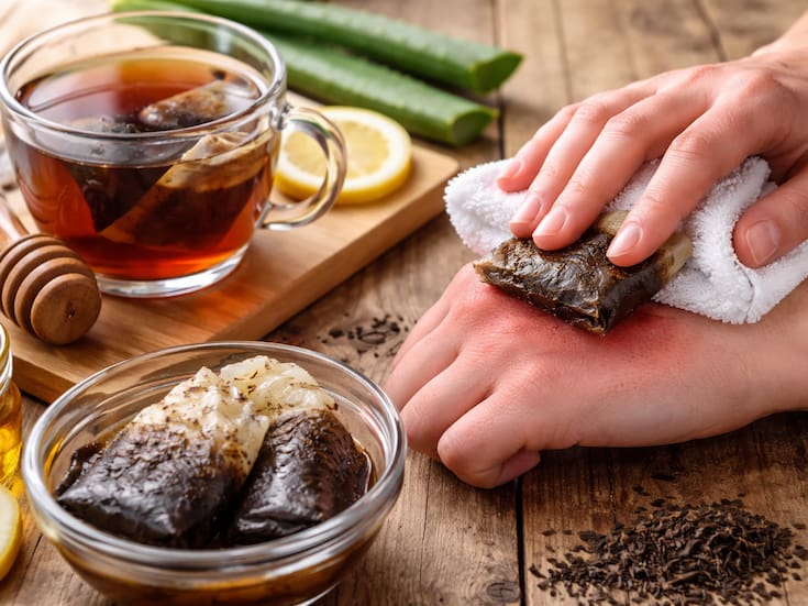Cómo calmar quemaduras leves con compresas de té negro