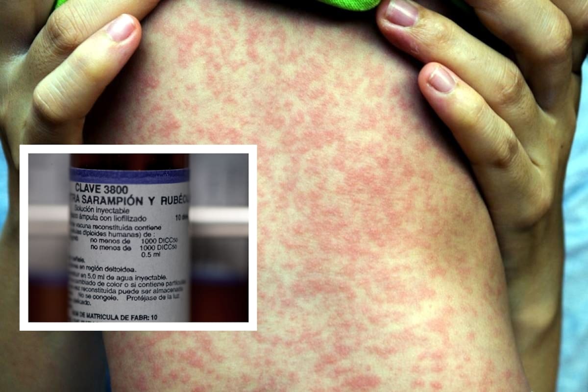 Alerta OMS por aumento de hasta 79% en casos de sarampión a nivel mundial