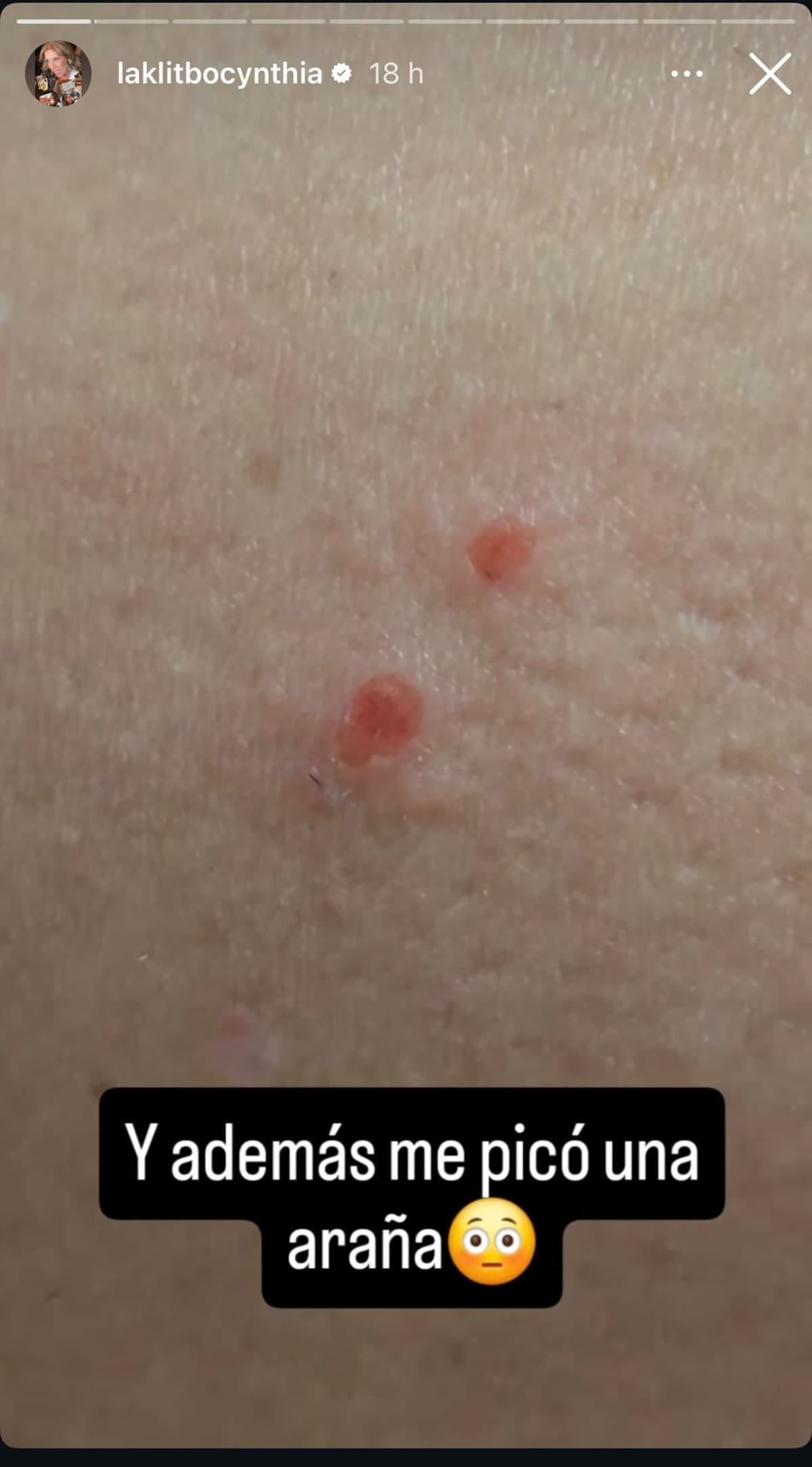 Las picaduras de esta especie pueden provocar dolor intenso | Foto: captura de pantalla Instagram (@laklitbocynthia)