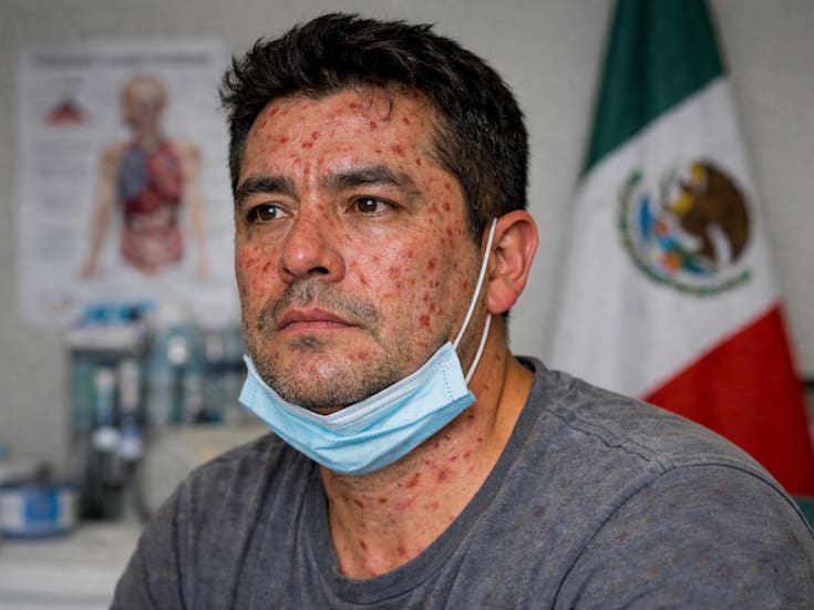 El dato más preocupante del Sarampión: Un solo enfermo puede contagiar a más de 10 personas y la propagación se acelera entre no vacunados