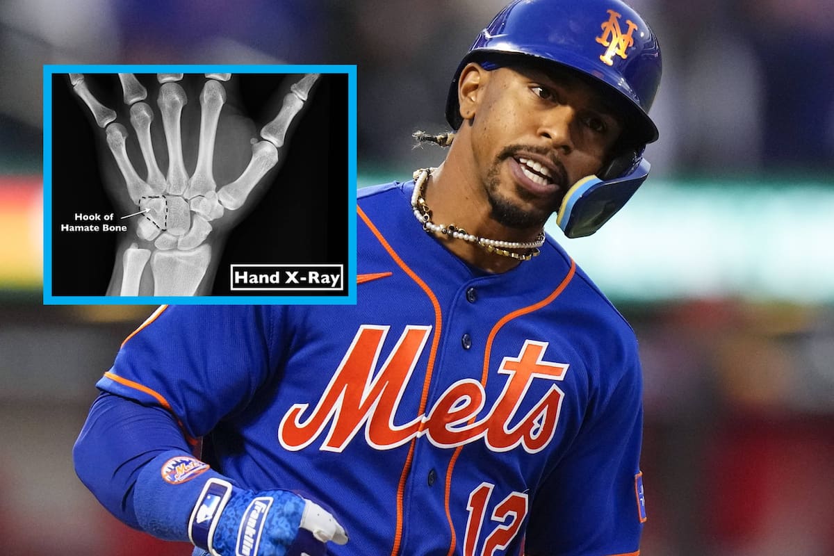 ¿De qué operarán a Francisco Lindor y cuándo podrá volver a jugar con los Mets?