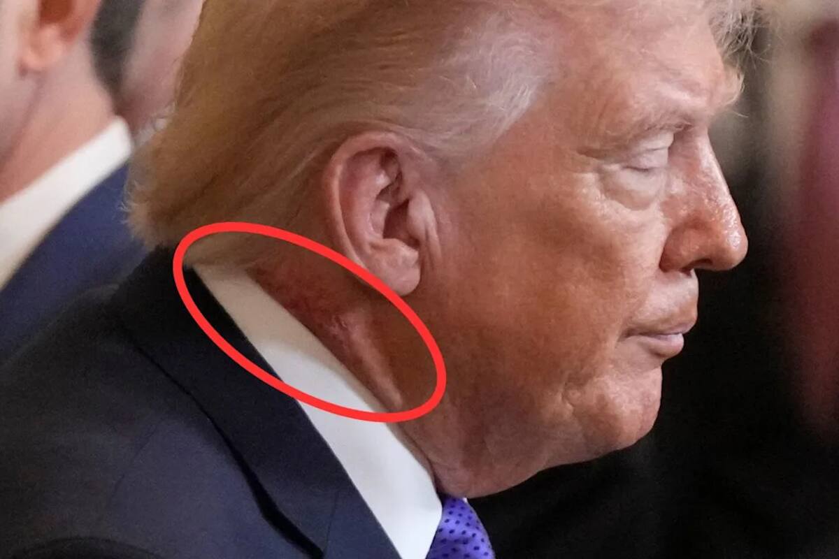 ¿Qué le salió en el cuello a Donald Trump y por qué hablan de “cankles”? Esto es lo que se sabe sobre su salud