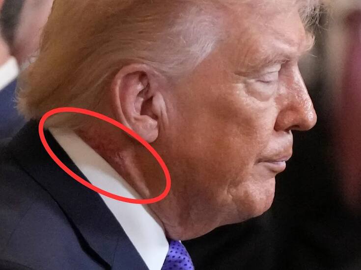 ¿Qué le salió en el cuello a Donald Trump y por qué hablan de “cankles”? Esto es lo que se sabe sobre su salud