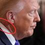 ¿Qué le salió en el cuello a Donald Trump y por qué hablan de “cankles”? Esto es lo que se sabe sobre su salud