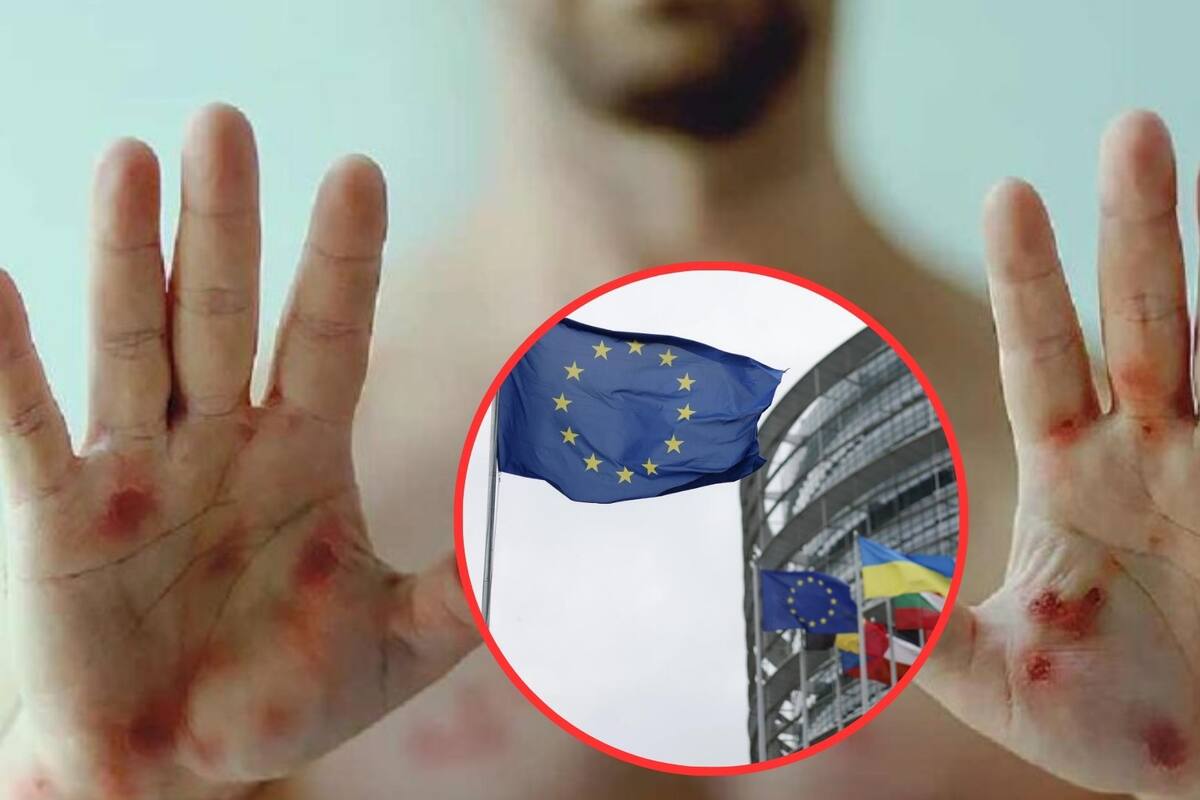 Crece en un 50% casos de Mpox en Unión Europea según Control de Enfermedades