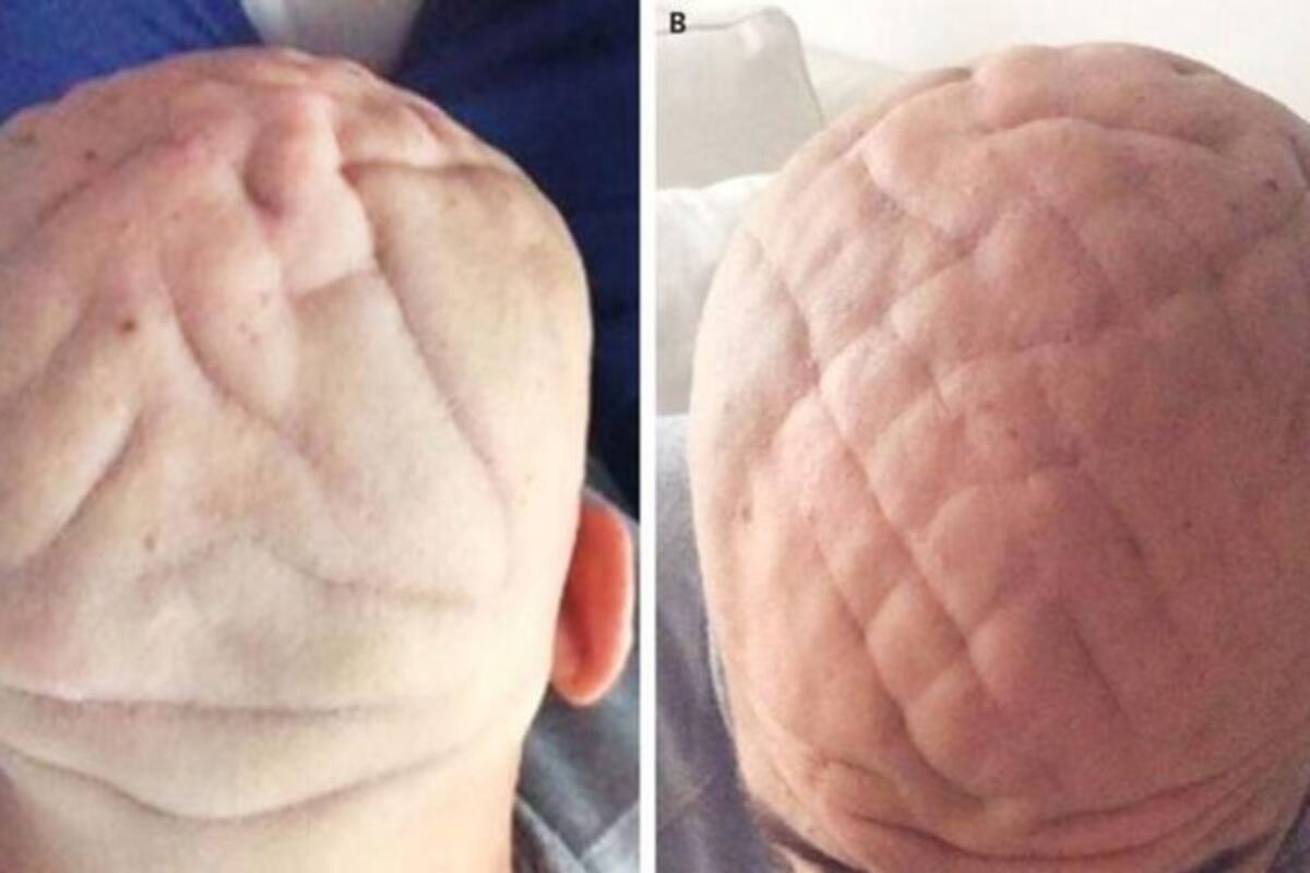 Su cuero cabelludo tenía pliegues como si fuera un cerebro