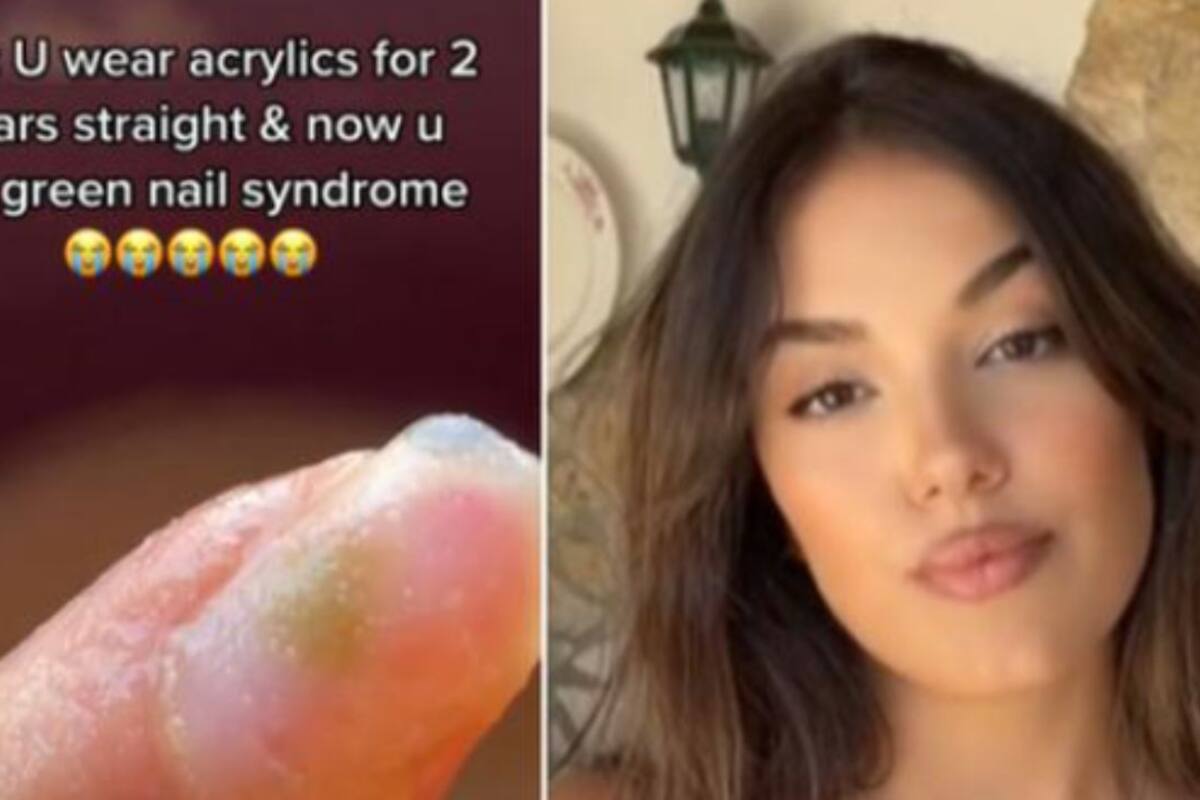 VIRAL:Chica usó uñas acrílicas durante 2 años seguidos y ahora sufre una gran infección