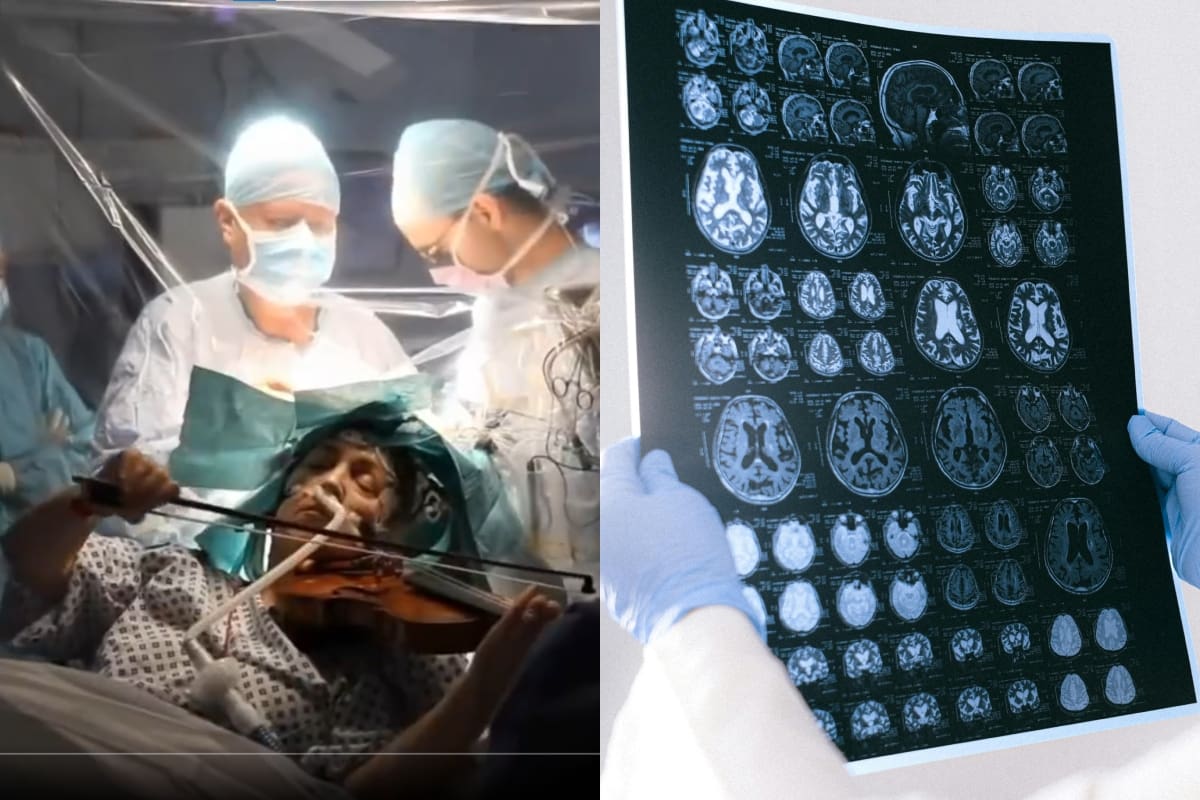 ¿Qué ocurre en las cirugías cerebrales sin anestesia? Músicos lo ejemplifican
