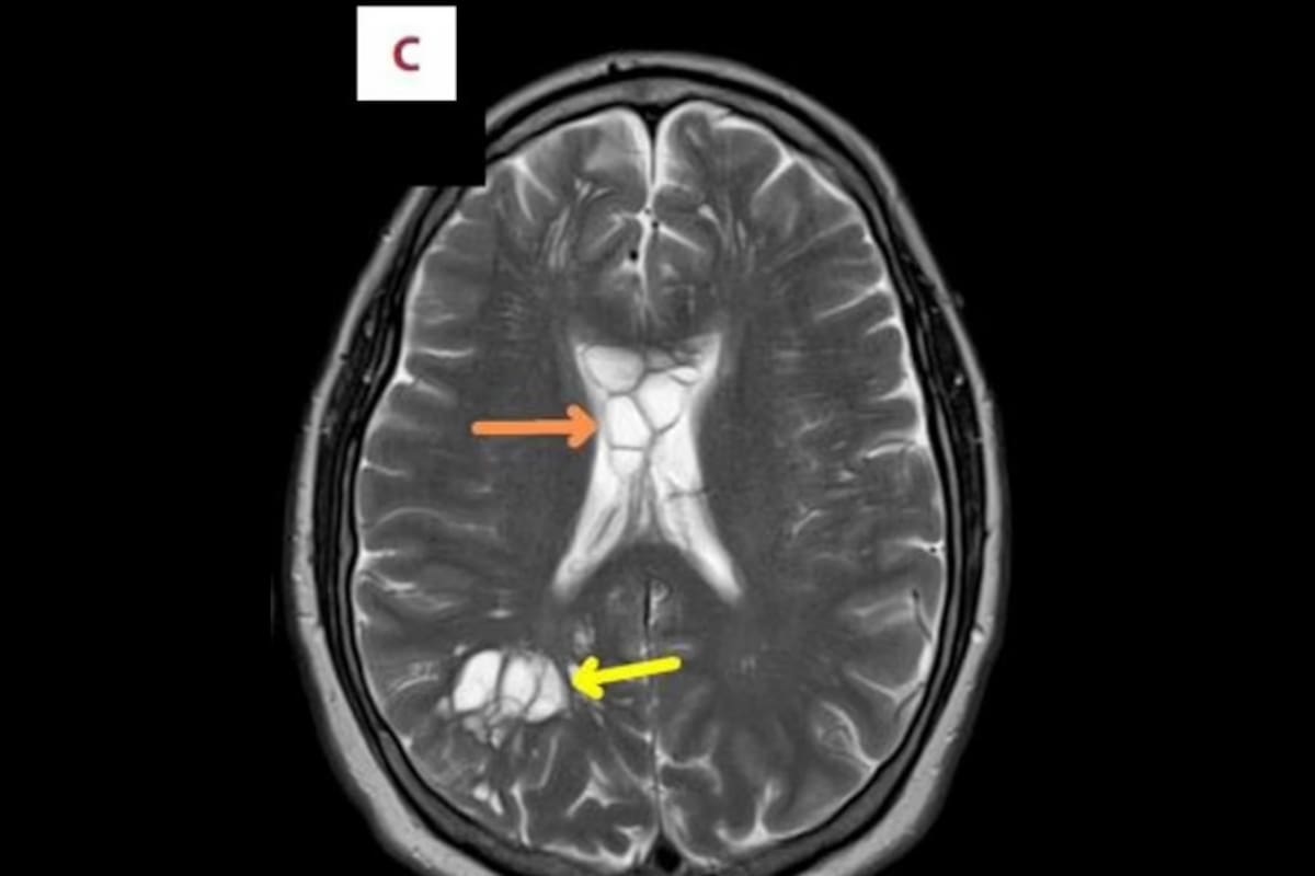 Descubren gusano en el cerebro de un hombre que sufría migrañas constantes