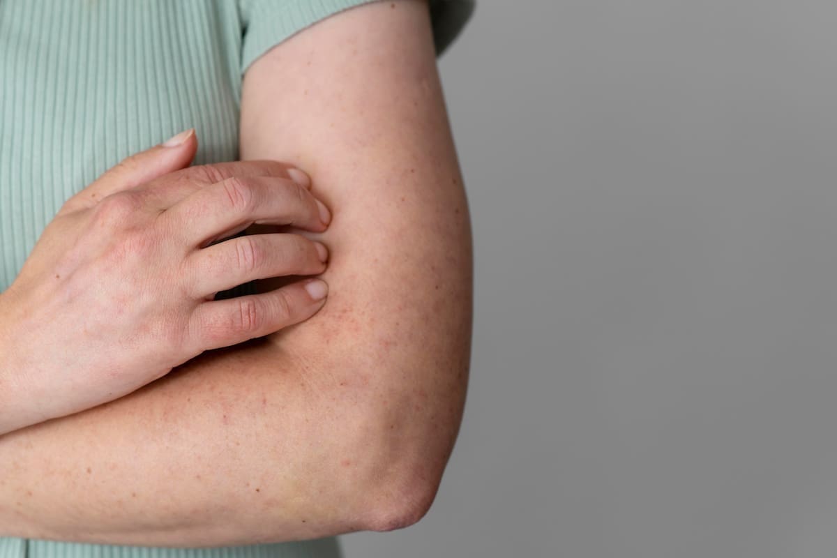 Suman 25 casos de sarampión en Baja California en lo que va de 2026