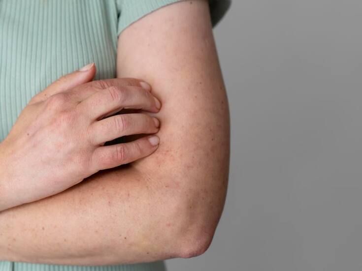 22 casos de sarampión en lo que va de 2026 en BC