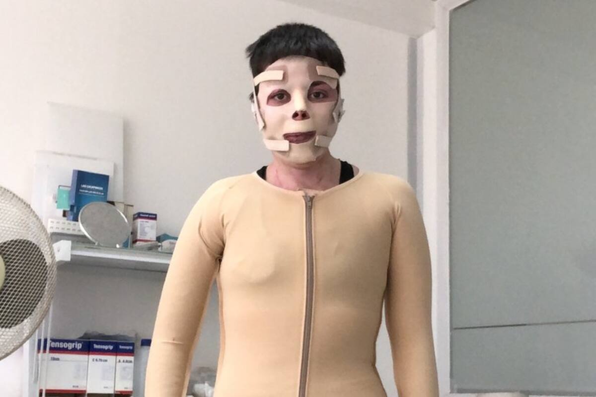 La inspiradora historia de Noelia Tabilo, la chilena que sobrevivió a un incendio que le quemó el 70% de su cuerpo