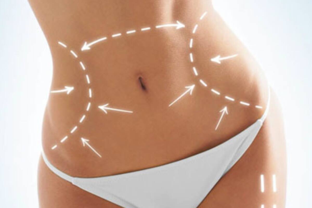 ¿Cuánto cuesta una lipotransferencia en México?