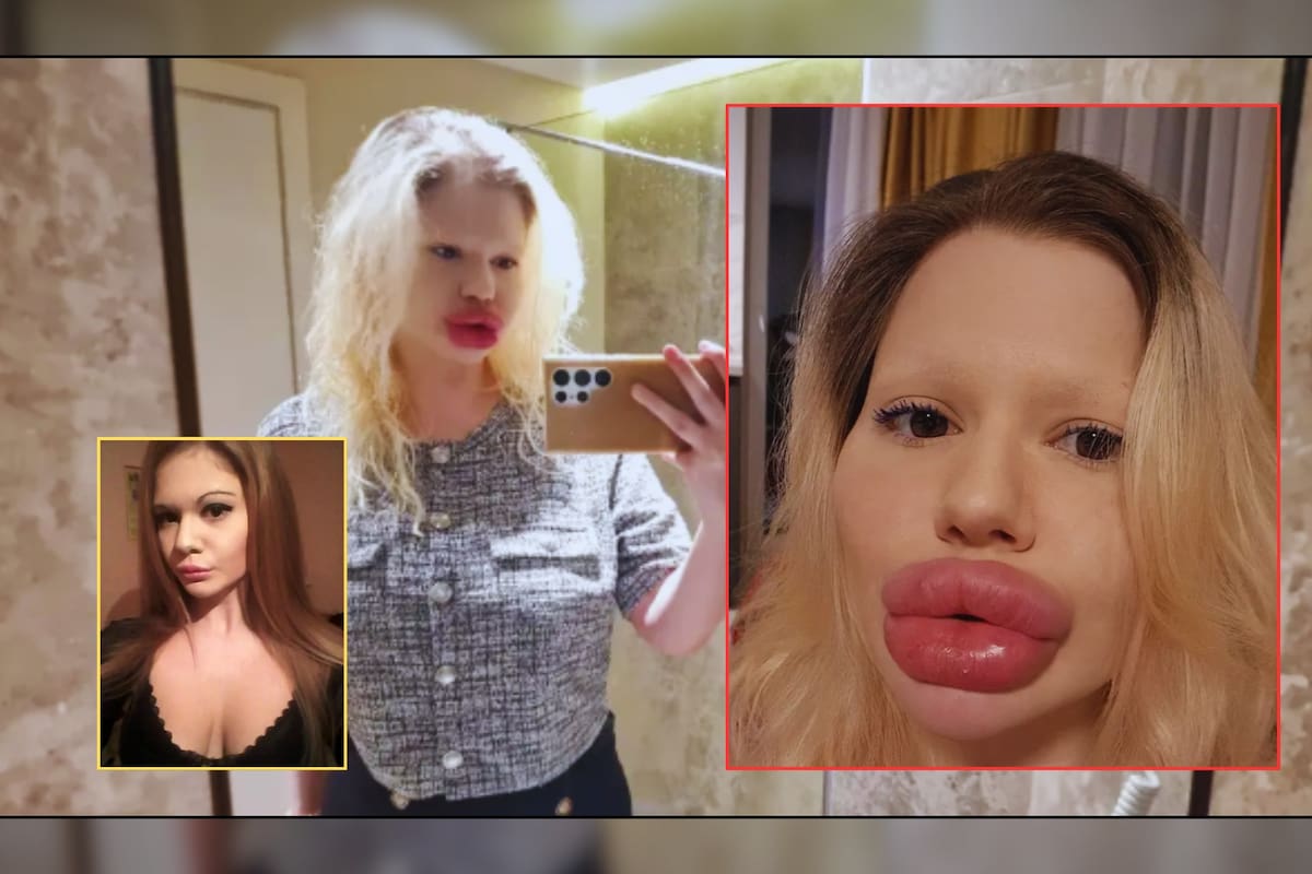Filtran fotos de cómo lucía la mujer con los labios más grandes del mundo antes de sus cirugías; busca más inyecciones aunque su salud está en riesgo