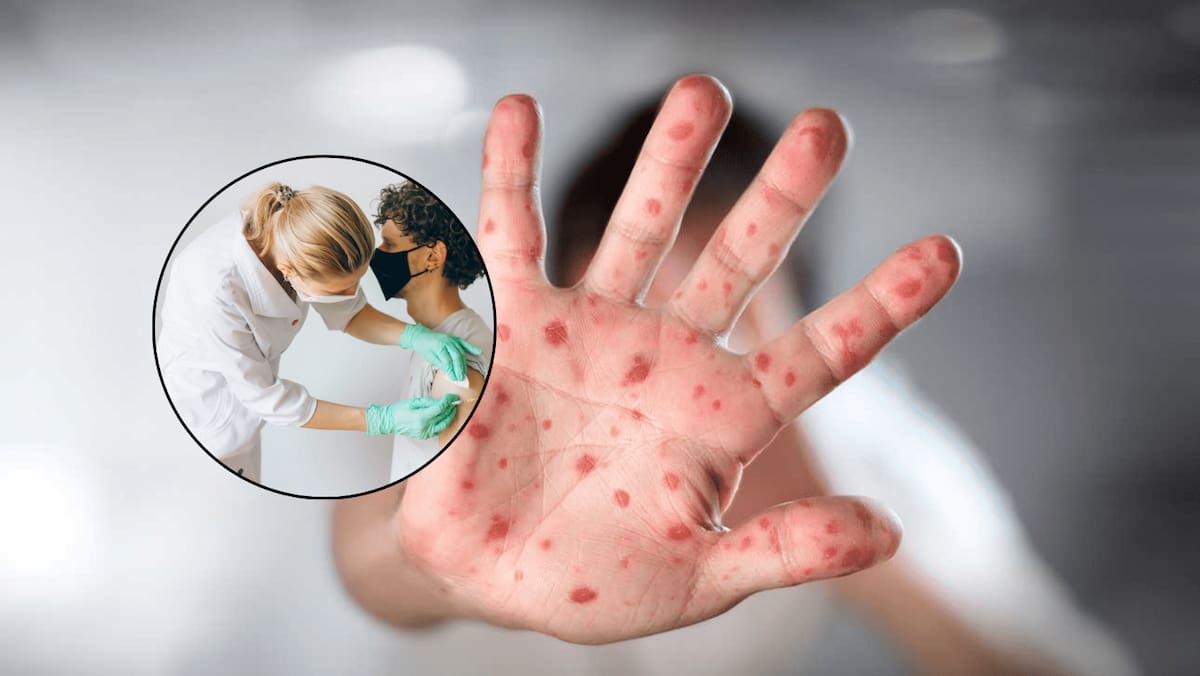 Al cierre de este año, México acumula 6 mil 50 casos de sarampión confirmados, contra los 3 mil 433 reportados al corte de 2024.