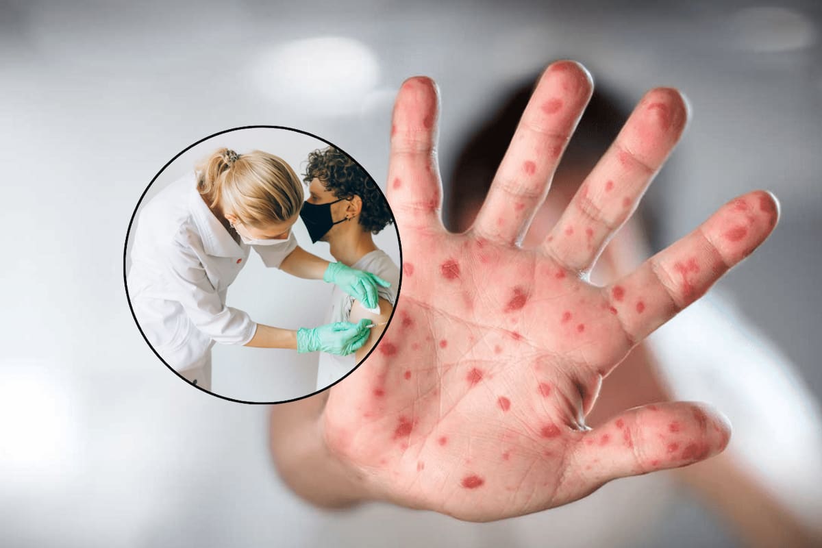 Registra Sonora nuevos casos de sarampión