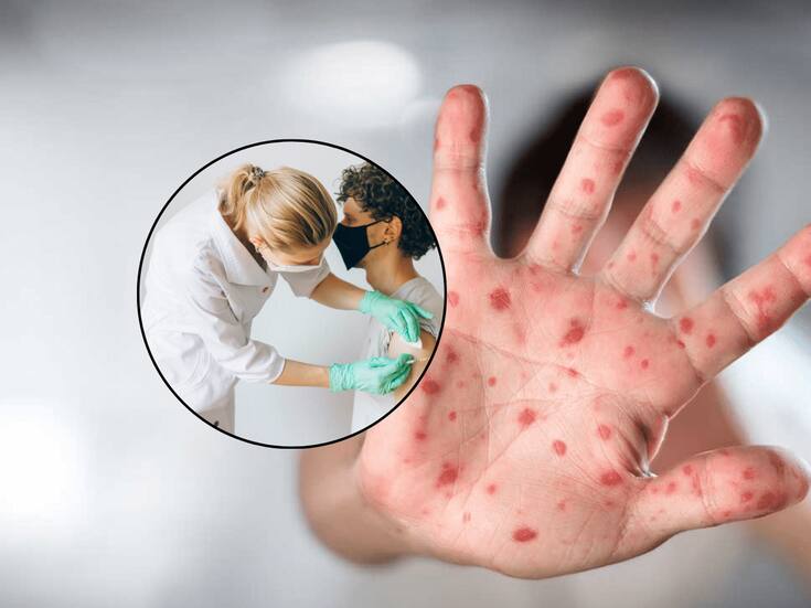 Registra Sonora nuevos casos de sarampión