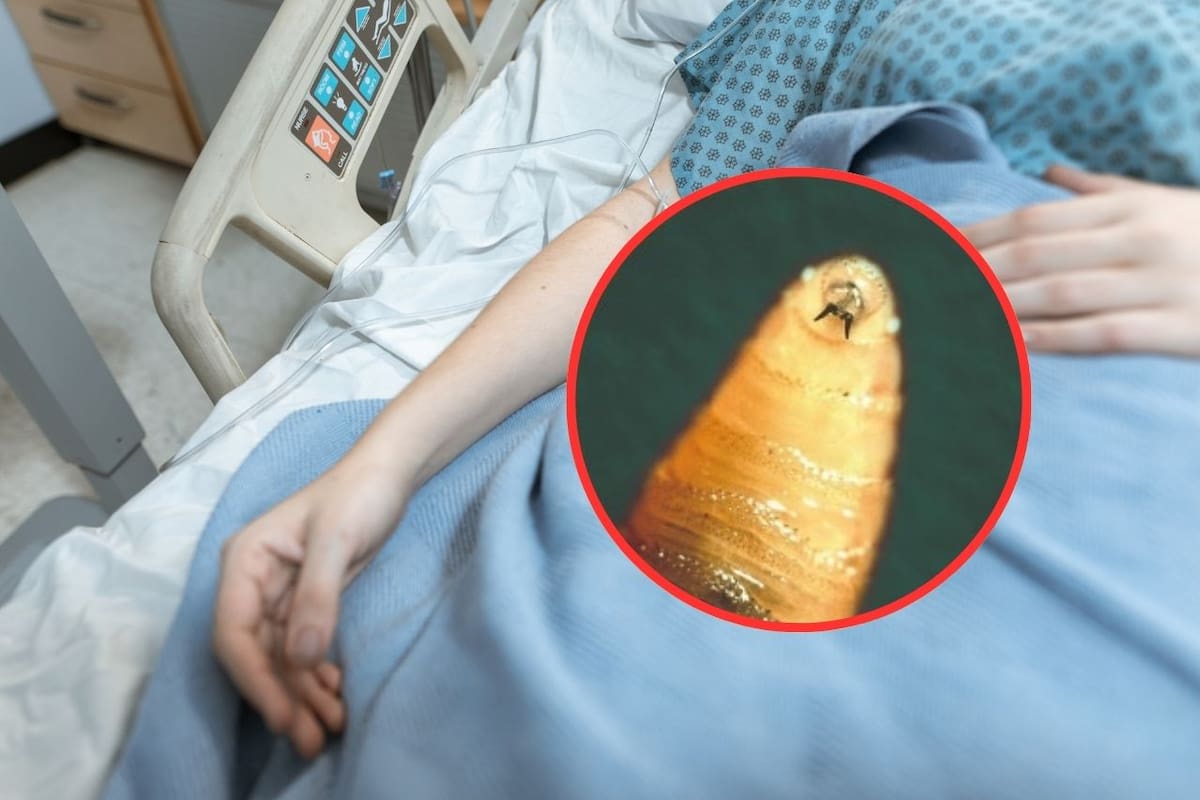 Fallece primer paciente por gusano barrenador tras complicaciones de cáncer de piel por infección de miasis en Campeche