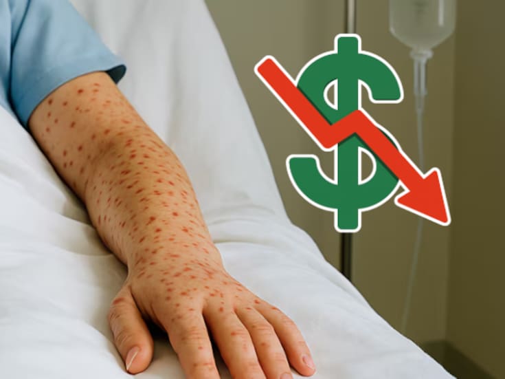 Sarampión al alza y recursos sin usar: lo que revela el informe de Salud sobre el gasto en epidemiología