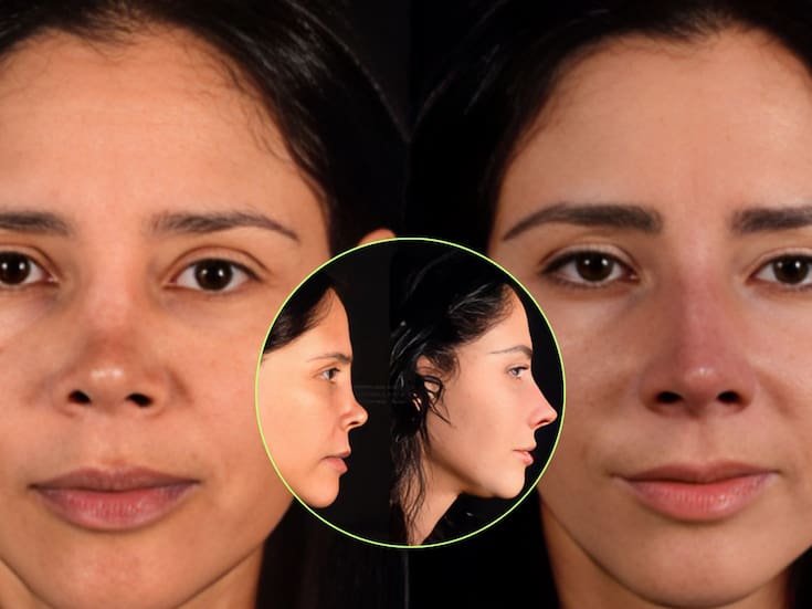 Dorismar comparte nuevos avances de su reconstrucción nasal tras complicaciones en una cirugía estética